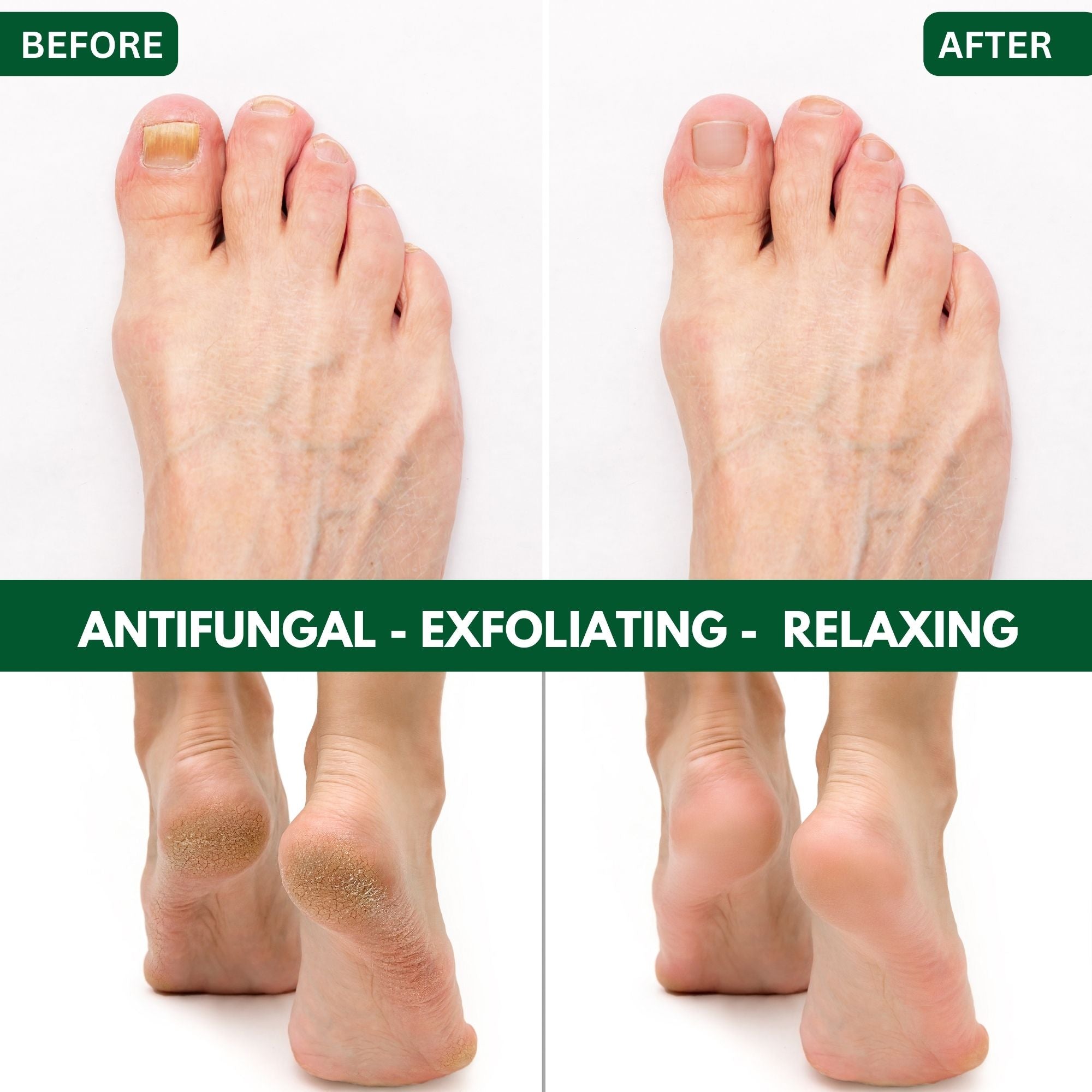 Before and after comparison of feet with antifungal, exfoliating, and relaxing effects.