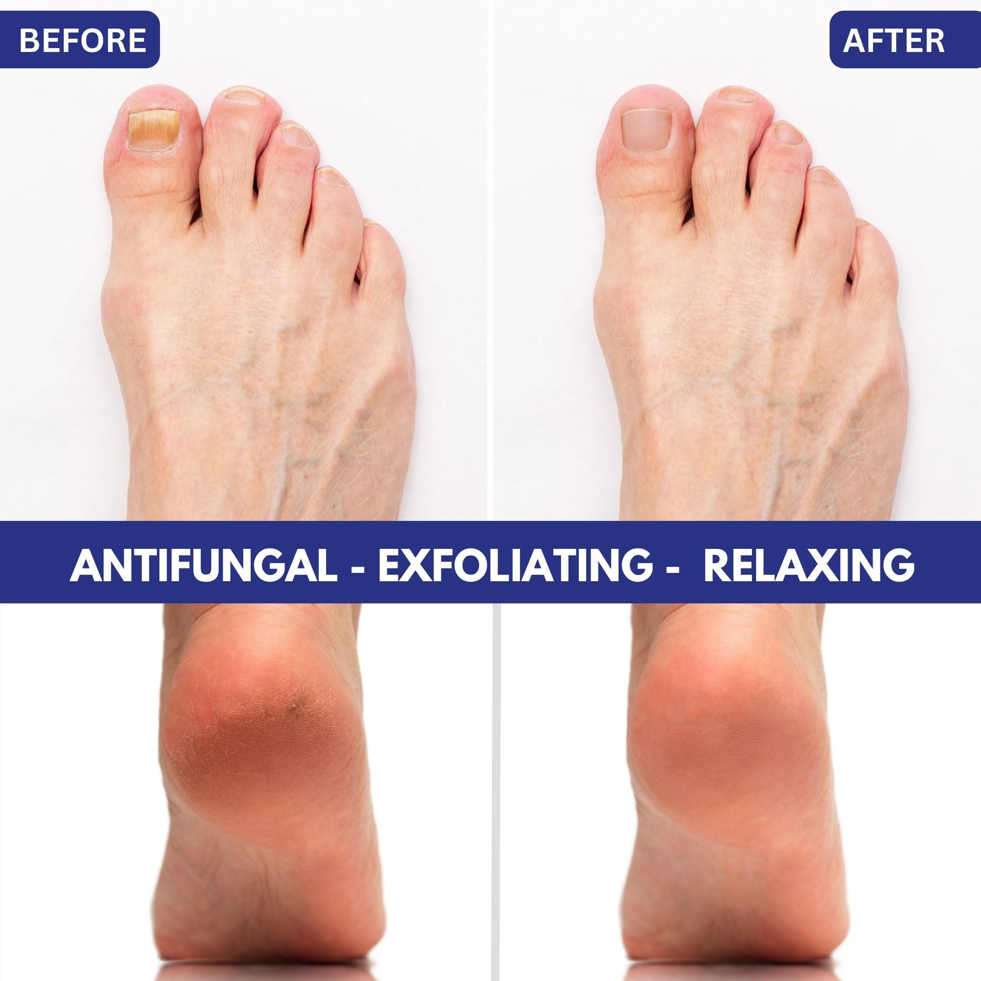 Before and after comparison of feet with antifungal, exfoliating, and relaxing effects.